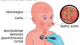 Число заболевших корью в Ростовской области увеличилось в два раза за месяц